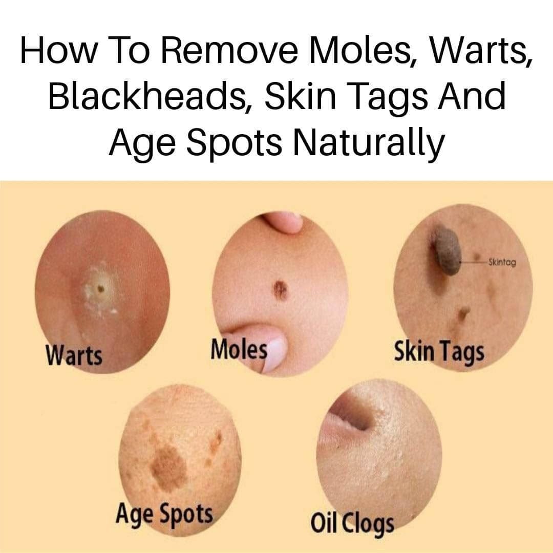 Natural Skin Care: What Can You Try To Remove Age Spots, Moles, Skin Tags, Warts, And Blackheads?