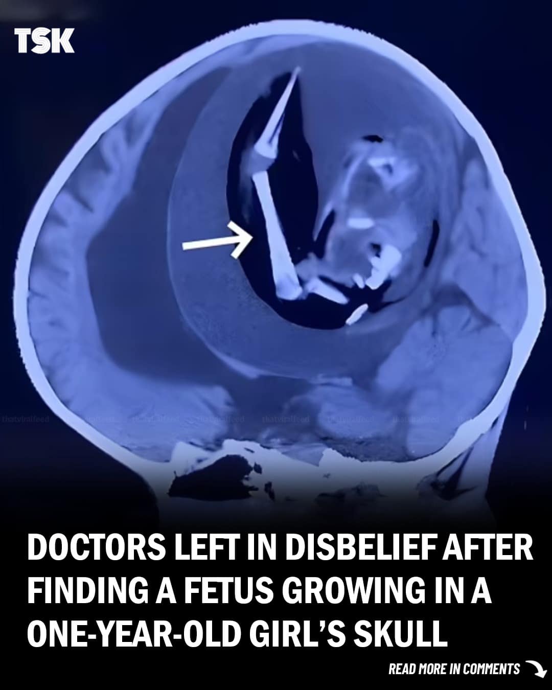 Doctors Shocked After Discovering Fetus Growing in Infant’s Skull