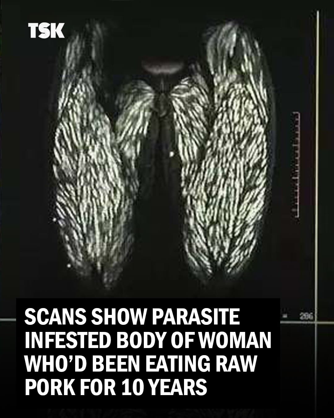 Scans Reveal Parasite-Infested Body of Woman Who Ate Large Amounts of Raw Pork for 10 Years