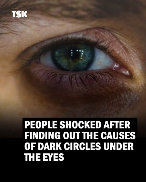 8 Reasons For Dark Circles Under The Eyes That Have Nothing to Do With Lack of Sleep