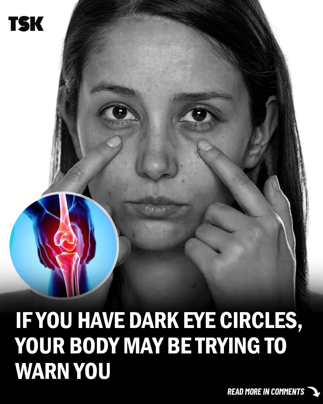 If You Have Dark Eye Circles, Your Body May Be Trying to Warn You