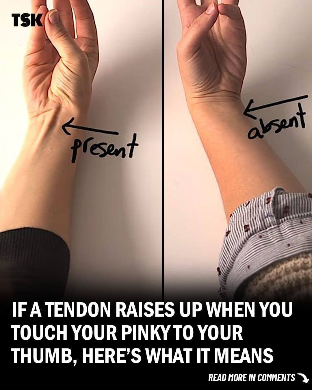 If a Tendon Raises Up When You Touch Your Pinky to Your Thumb, Here’s What It Could Mean
