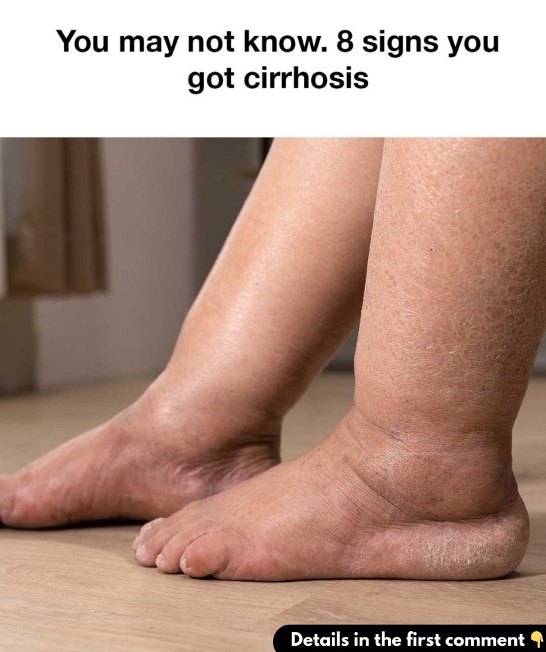 You may not know. 8 signs you got cirrhosis