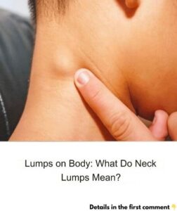 Lumps on Body: What Do Neck Lumps Mean?